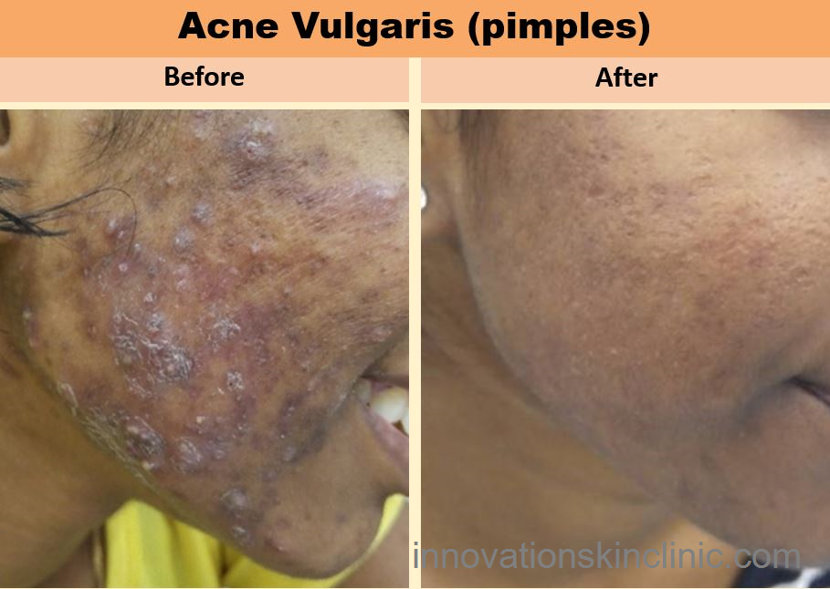 Acne Vulgaris Pimples 3